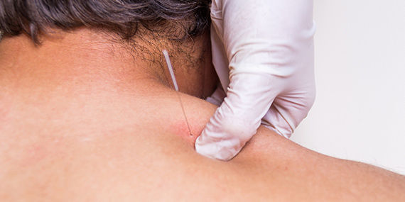 A man receives a needle in his shoulder as part of a Dry Needling procedure
